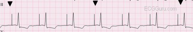 Ecg strips pacemaker ⭐ ECG Quiz